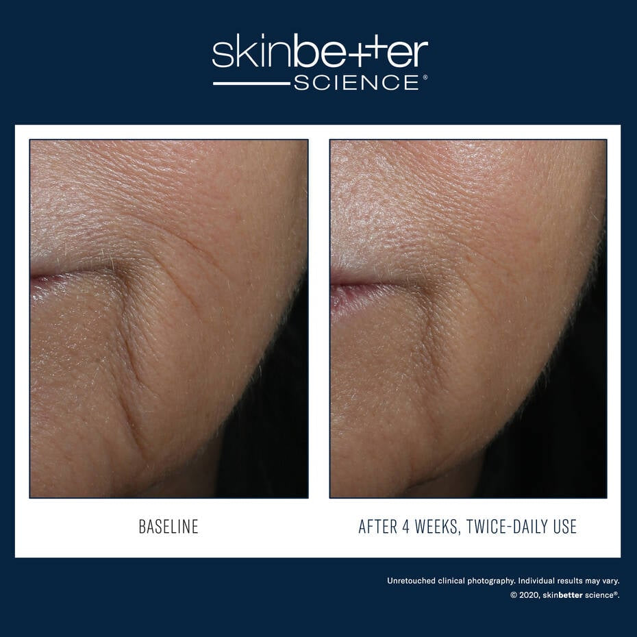 Skin Better: InterFuse Intensive Treatment LINES