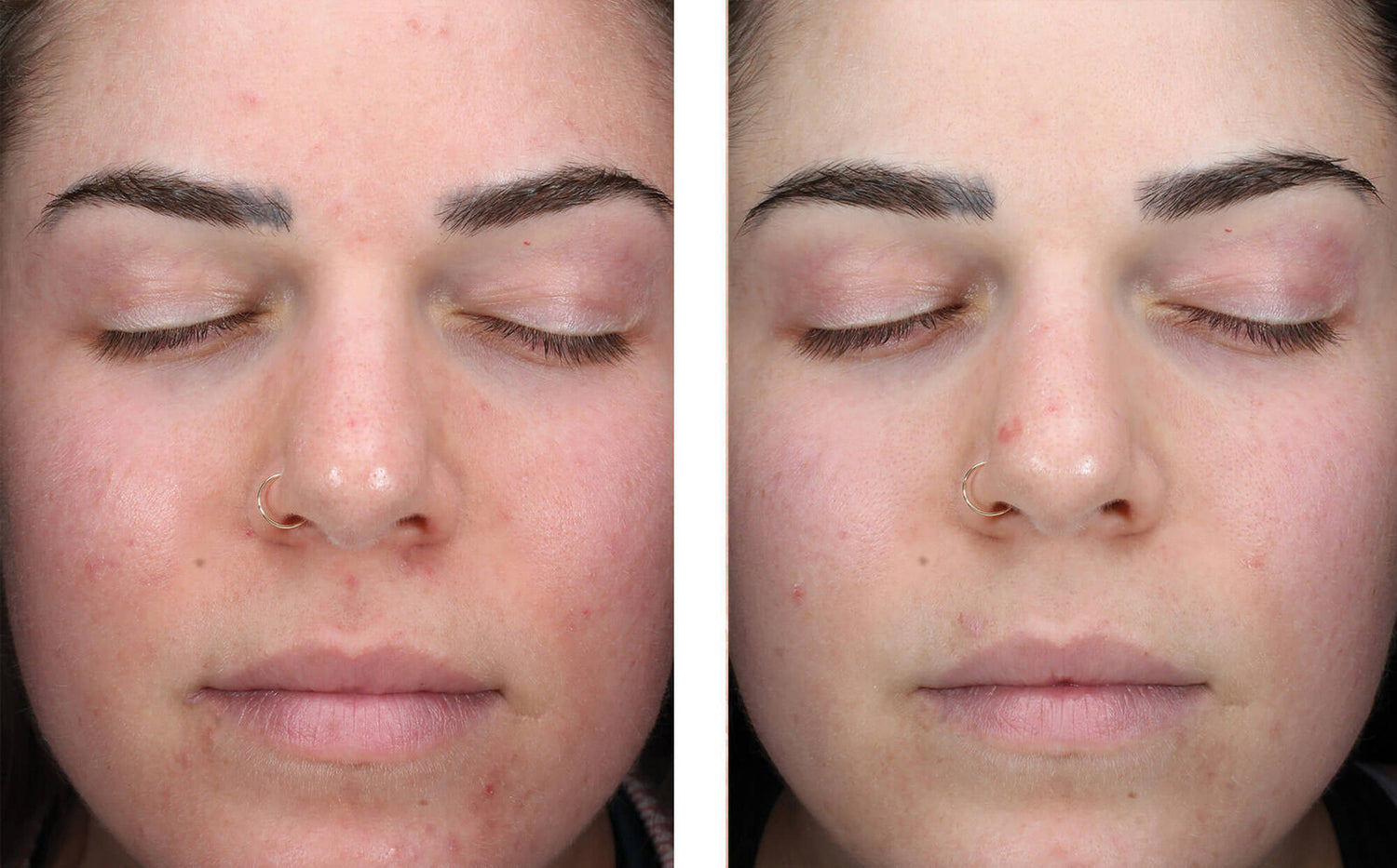 Skin Better Science: AlphaRet Clearing Serum